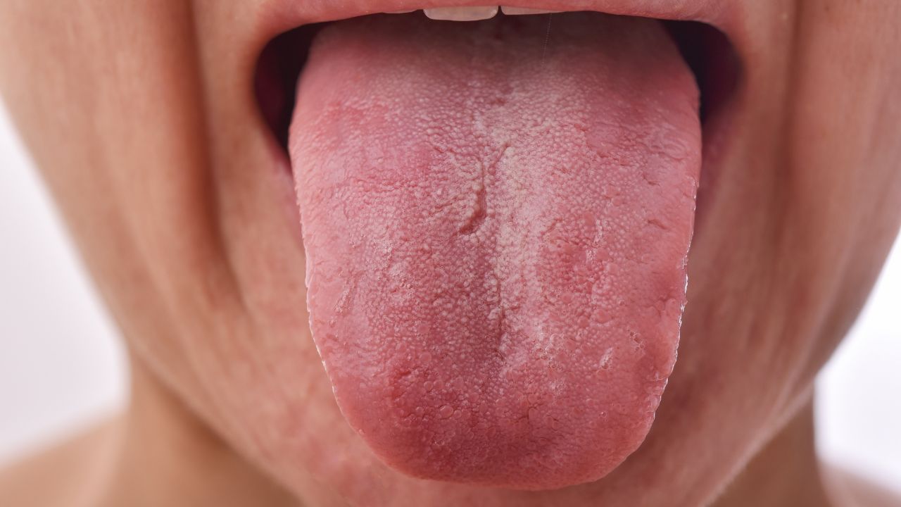 Understanding Ridges in the Tongue Causes and Implications